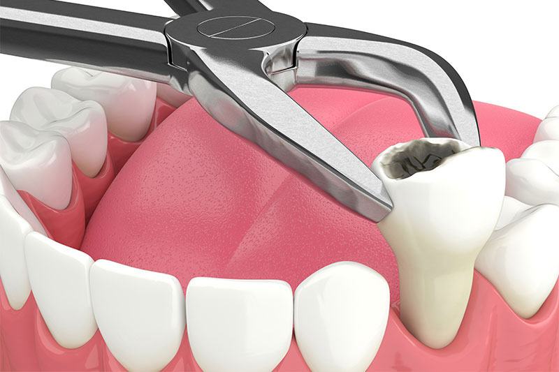 Single Tooth Extraction in Cedar Park