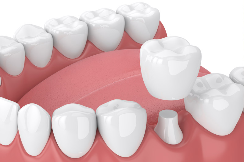 Dental Crowns in Cedar Park
