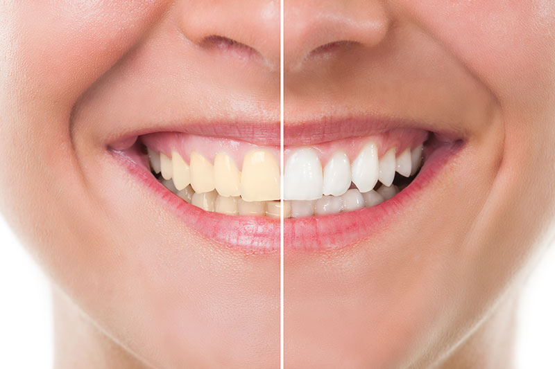 Teeth Whitening in Cedar Park