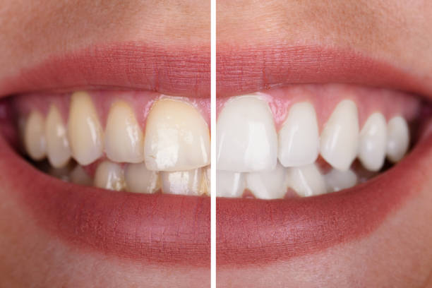 close up of before and after image of teeth whitening